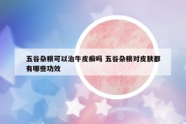 五谷雜糧可以治牛皮癬嗎 五谷雜糧對皮膚都有哪些功效
