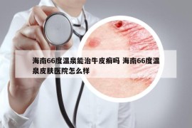 海南66度溫泉能治牛皮癬嗎 海南66度溫泉皮膚醫(yī)院怎么樣