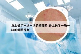 身上長(zhǎng)了一塊一塊的癬圖片 身上長(zhǎng)了一塊一塊的癬圖片女