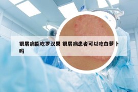 銀屑病能吃羅漢果 銀屑病患者可以吃白蘿卜嗎