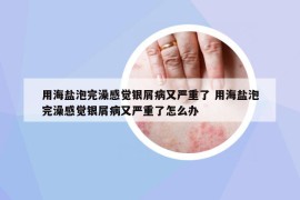 用海鹽泡完澡感覺銀屑病又嚴(yán)重了 用海鹽泡完澡感覺銀屑病又嚴(yán)重了怎么辦