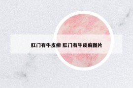 肛門有牛皮癬 肛門有牛皮癬圖片