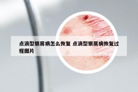 點(diǎn)滴型銀屑病怎么恢復(fù) 點(diǎn)滴型銀屑病恢復(fù)過程圖片