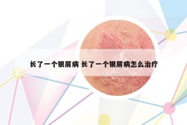 長了一個銀屑病 長了一個銀屑病怎么治療