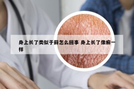 身上長了類似于蘚怎么回事 身上長了像癬一樣