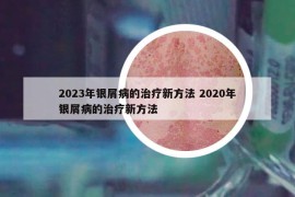 2023年銀屑病的治療新方法 2020年銀屑病的治療新方法