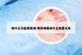 缺什么引起銀屑病 銀屑病是缺什么微量元素