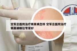 空軍總醫(yī)院治療銀屑病怎樣 空軍總醫(yī)院治療銀屑病哪位專家好