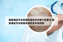 銀屑病關(guān)節(jié)炎和類風(fēng)濕關(guān)節(jié)炎哪個(gè)危害大 銀屑病關(guān)節(jié)炎和類風(fēng)濕性關(guān)節(jié)炎區(qū)別