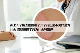身上長了癬去醫(yī)院看了開了藥還是不見好是為什么 皮膚癬擦了藥為什么特別癢