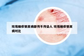 玫瑰糠疹銀屑病都傳不傳染人 玫瑰糠疹銀屑病對比