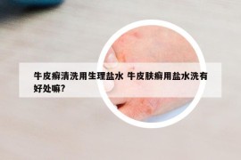 牛皮癬清洗用生理鹽水 牛皮膚癬用鹽水洗有好處嘛?