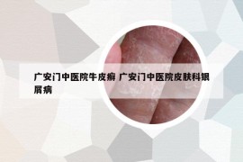 廣安門中醫(yī)院牛皮癬 廣安門中醫(yī)院皮膚科銀屑病