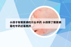 小孩子有銀屑病吃什么中藥 小孩得了銀屑病是吃中藥還是西藥