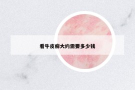 看牛皮癬大約需要多少錢