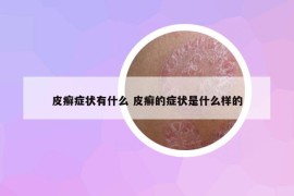 皮癬癥狀有什么 皮癬的癥狀是什么樣的