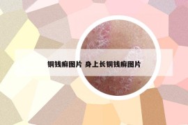 銅錢癬圖片 身上長銅錢癬圖片
