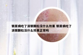 銀屑病吃了消銀顆粒沒什么效果 銀屑病吃了消銀顆粒沒什么效果正常嗎