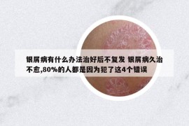 銀屑病有什么辦法治好后不復(fù)發(fā) 銀屑病久治不愈,80%的人都是因為犯了這4個錯誤
