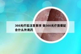 308光療后注意事項 做308光療需要配合什么外用藥