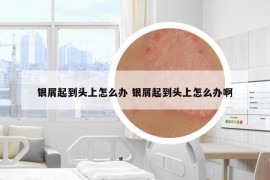 銀屑起到頭上怎么辦 銀屑起到頭上怎么辦啊