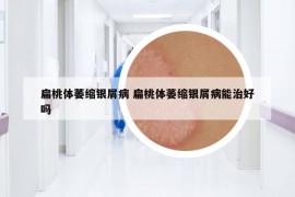 扁桃體萎縮銀屑病 扁桃體萎縮銀屑病能治好嗎