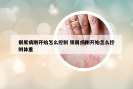 銀屑病剛開始怎么控制 銀屑病剛開始怎么控制體重