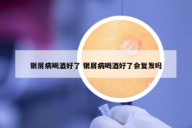 銀屑病喝酒好了 銀屑病喝酒好了會(huì)復(fù)發(fā)嗎