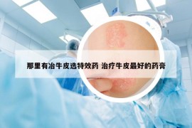 那里有冶牛皮選特效藥 治療牛皮最好的藥膏