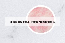 皮膚起癬檢查血不 皮膚癬上醫(yī)院檢查什么
