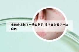 小孩身上長(zhǎng)了一塊白色的 孩子身上長(zhǎng)了一塊白色