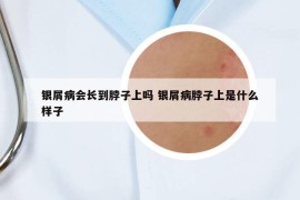 銀屑病會長到脖子上嗎 銀屑病脖子上是什么樣子