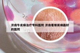 濟南牛皮癬治療?？漆t(yī)院 濟南看銀屑病最好的醫(yī)院