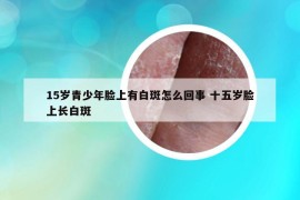 15歲青少年臉上有白斑怎么回事 十五歲臉上長白斑