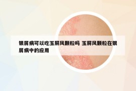 銀屑病可以吃玉屏風(fēng)顆粒嗎 玉屏風(fēng)顆粒在銀屑病中的應(yīng)用