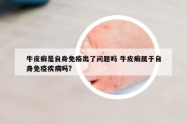 牛皮癬是自身免疫出了問題嗎 牛皮癬屬于自身免疫疾病嗎?