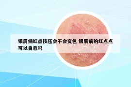 銀屑病紅點按壓會不會變色 銀屑病的紅點點可以自愈嗎