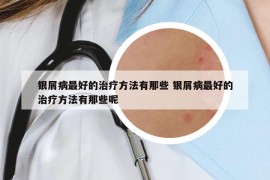 銀屑病最好的治療方法有那些 銀屑病最好的治療方法有那些呢