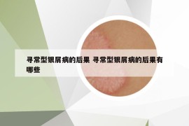 尋常型銀屑病的后果 尋常型銀屑病的后果有哪些