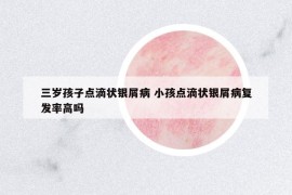 三歲孩子點(diǎn)滴狀銀屑病 小孩點(diǎn)滴狀銀屑病復(fù)發(fā)率高嗎