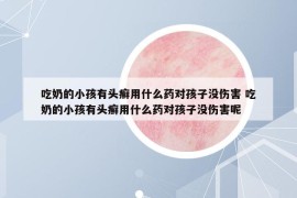 吃奶的小孩有頭癬用什么藥對(duì)孩子沒(méi)傷害 吃奶的小孩有頭癬用什么藥對(duì)孩子沒(méi)傷害呢
