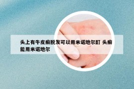 頭上有牛皮癬脫發(fā)可以用米諾地爾酊 頭癬 能用米諾地爾