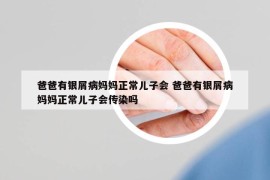 爸爸有銀屑病媽媽正常兒子會(huì) 爸爸有銀屑病媽媽正常兒子會(huì)傳染嗎