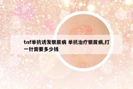 tnf單抗誘發(fā)銀屑病 單抗治療銀屑病,打一針需要多少錢