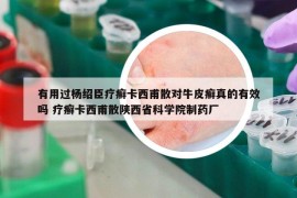有用過楊紹臣療癬卡西甫散對牛皮癬真的有效嗎 療癬卡西甫散陜西省科學(xué)院制藥廠