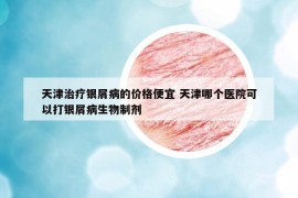 天津治療銀屑病的價(jià)格便宜 天津哪個(gè)醫(yī)院可以打銀屑病生物制劑