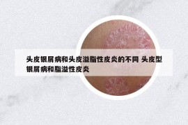 頭皮銀屑病和頭皮溢脂性皮炎的不同 頭皮型銀屑病和脂溢性皮炎