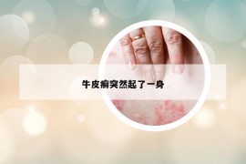 牛皮癬突然起了一身