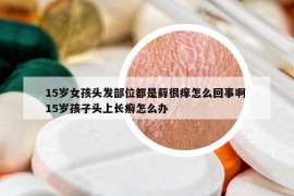 15歲女孩頭發(fā)部位都是蘚很癢怎么回事啊 15歲孩子頭上長(zhǎng)癬怎么辦