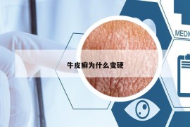 牛皮癬為什么變硬